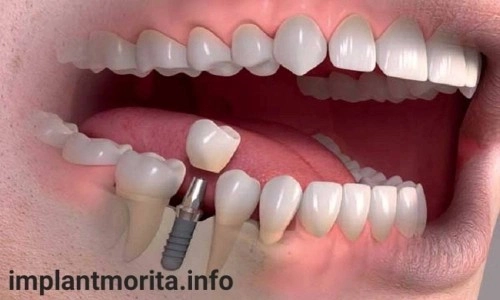 قیمت ایمپلنت دندان در اصفهان