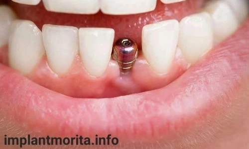 قیمت ایمپلنت دندان در اصفهان