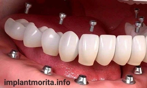 قیمت ایمپلنت دندان در اصفهان