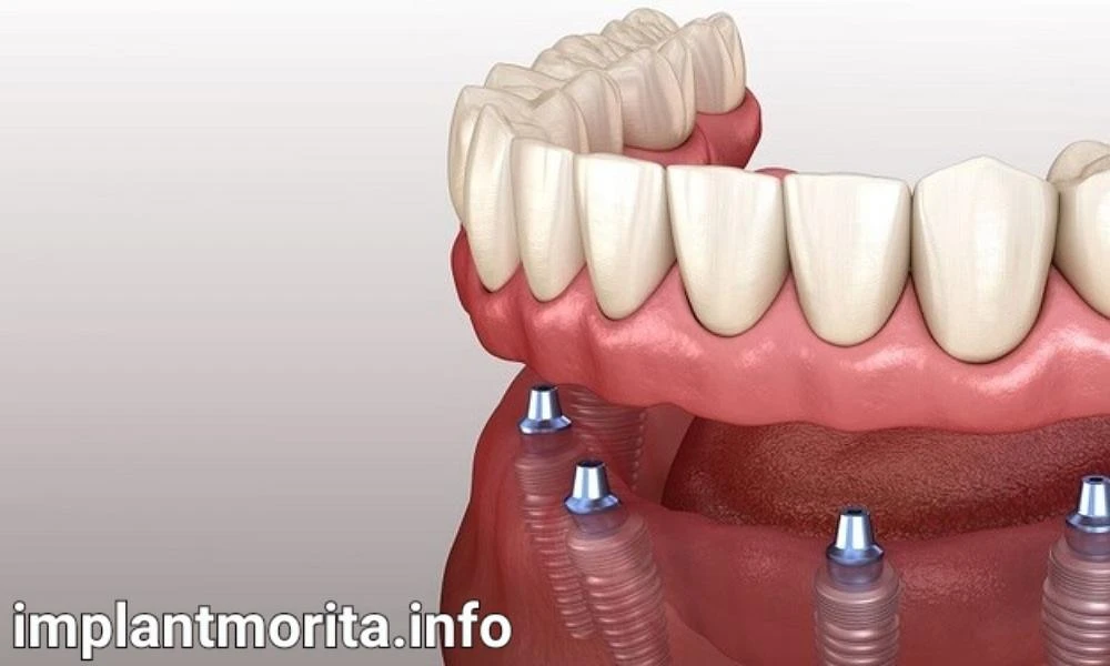 قیمت ایمپلنت دندان در قم