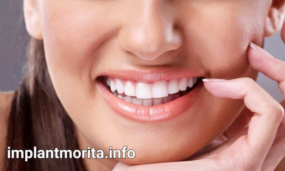 قیمت ایمپلنت دندان در یاسوج