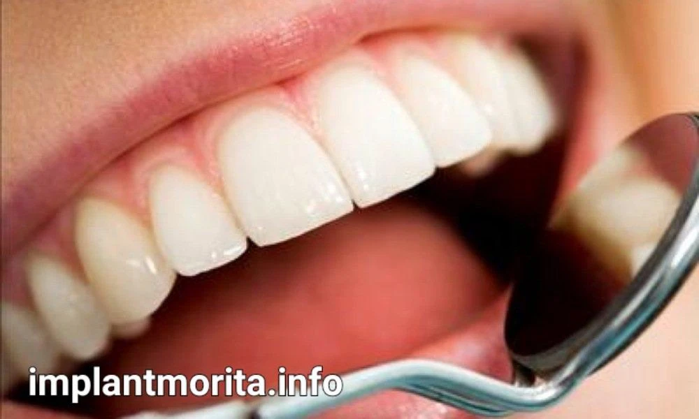 قیمت ایمپلنت دندان در یاسوج