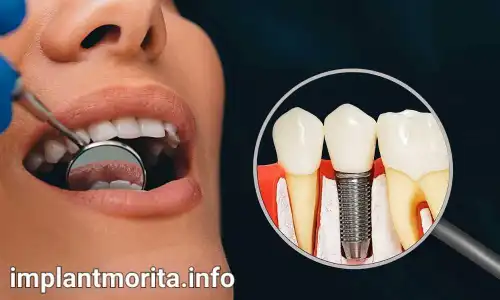 قیمت ایمپلنت دندان در ساری