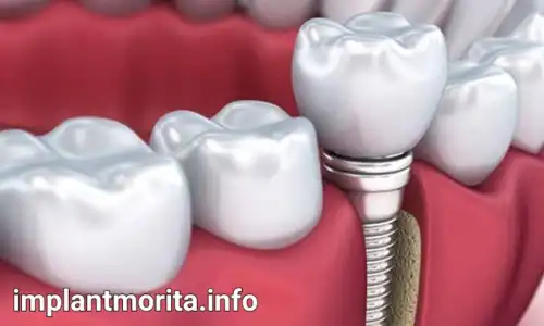قیمت ایمپلنت دندان در ساری