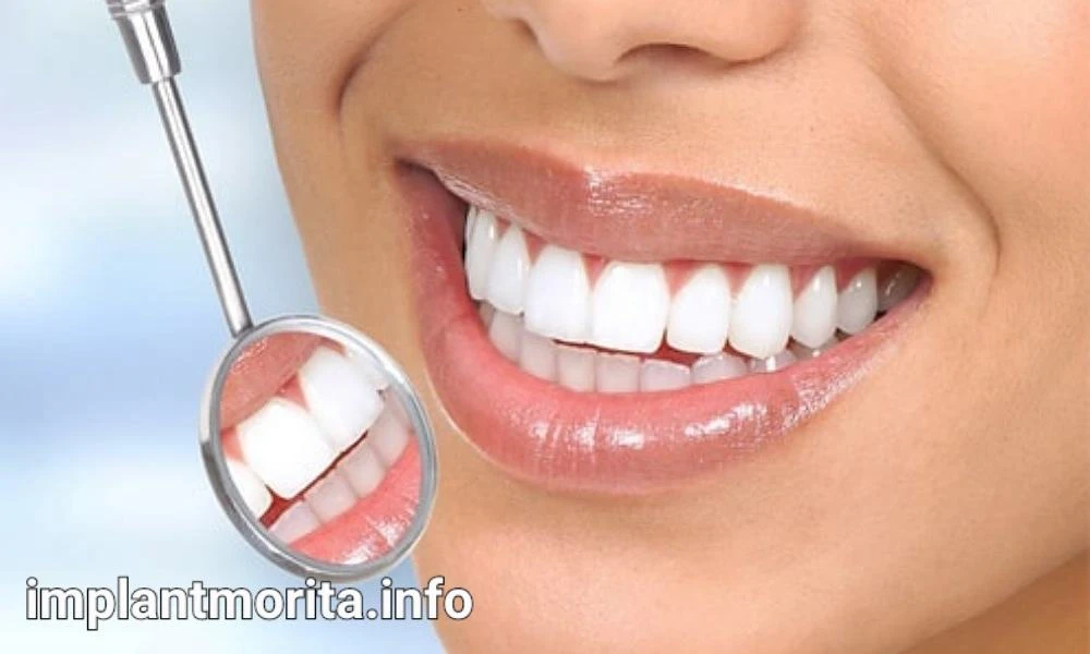 قیمت ایمپلنت دندان در سنندج