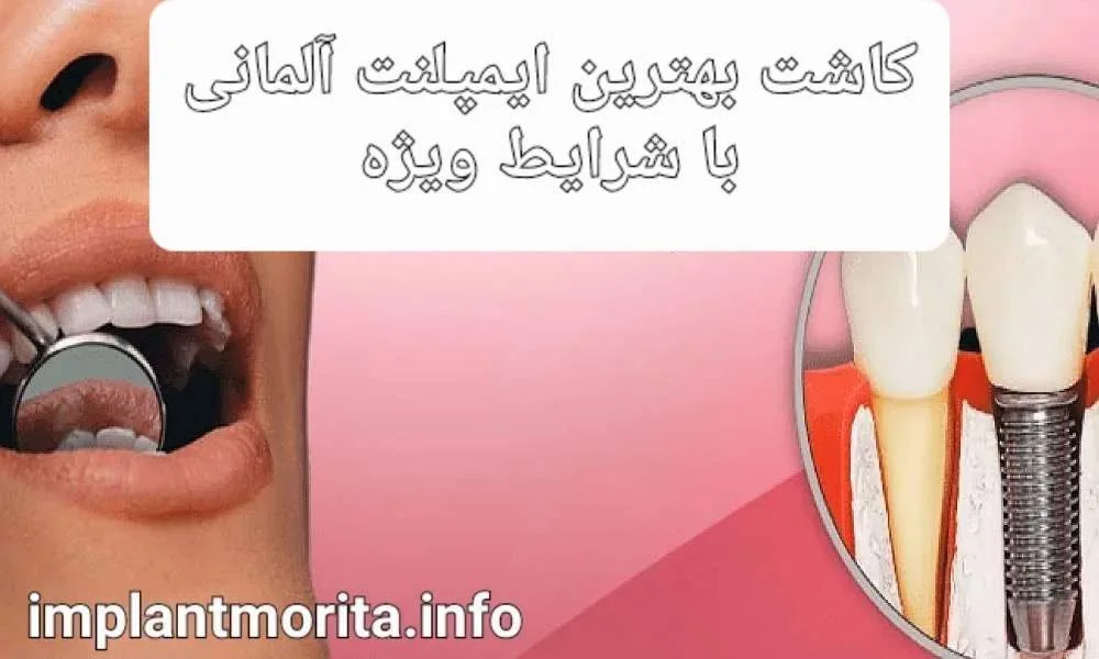 ایمپلنت آلمانی چیست