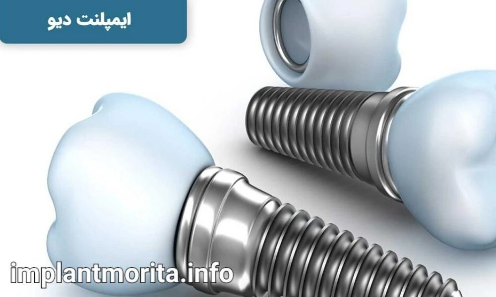 بهترین برند ایمپلنت دندان