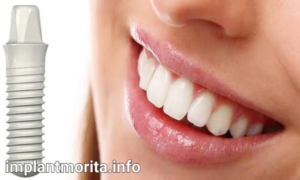 بهترین برند ایمپلنت دندان