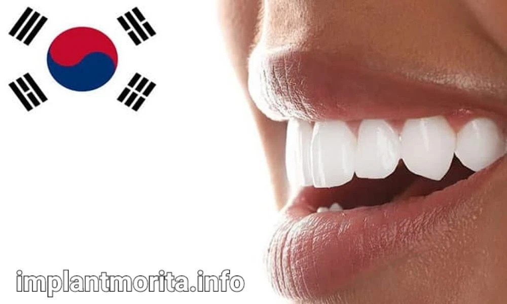 قیمت ایمپلنت کره‌ای