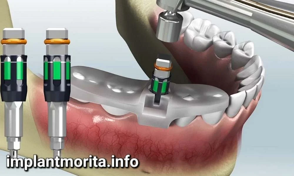 ایمپلنت دیجیتال چیست