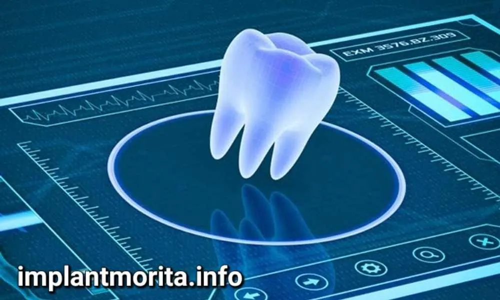 ایمپلنت دیجیتال چیست