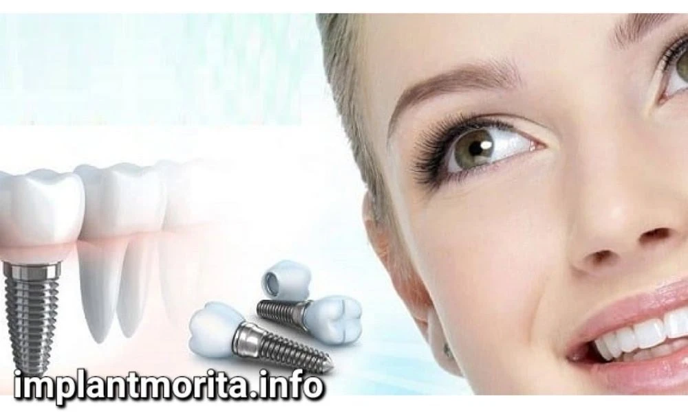 مقایسه ایمپلنت فوری و ایمپلنت معمولی