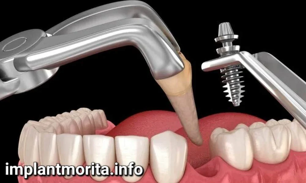 مقایسه ایمپلنت فوری و ایمپلنت معمولی