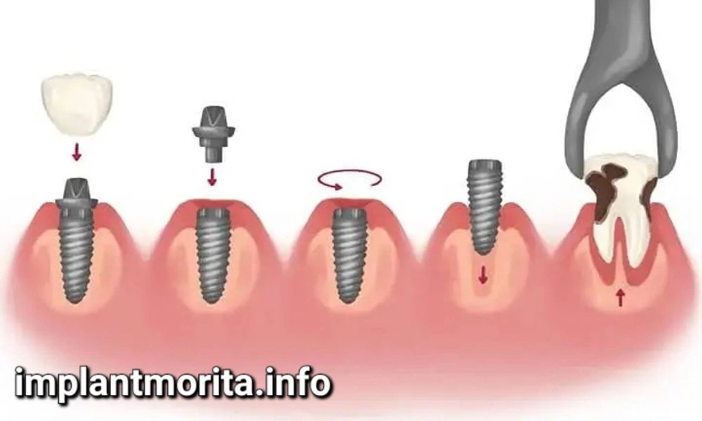 مقایسه ایمپلنت فوری و ایمپلنت معمولی