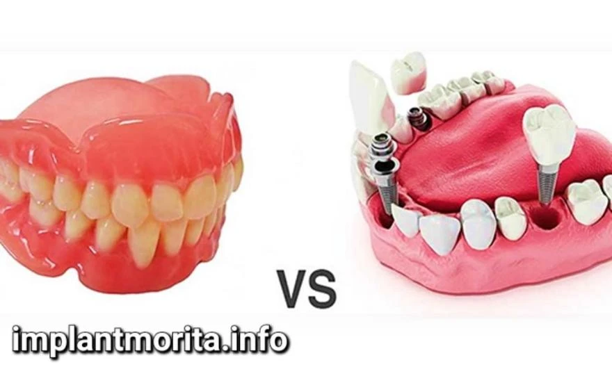 ایمپلنت یا دندان مصنوعی
