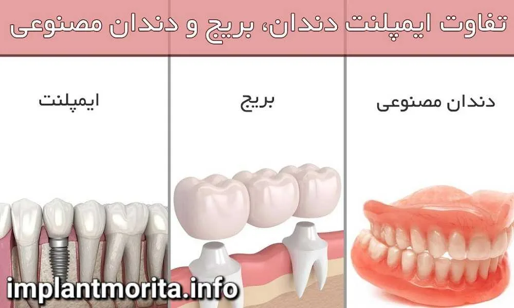 ایمپلنت یا دندان مصنوعی