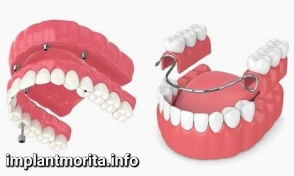 ایمپلنت یا دندان مصنوعی