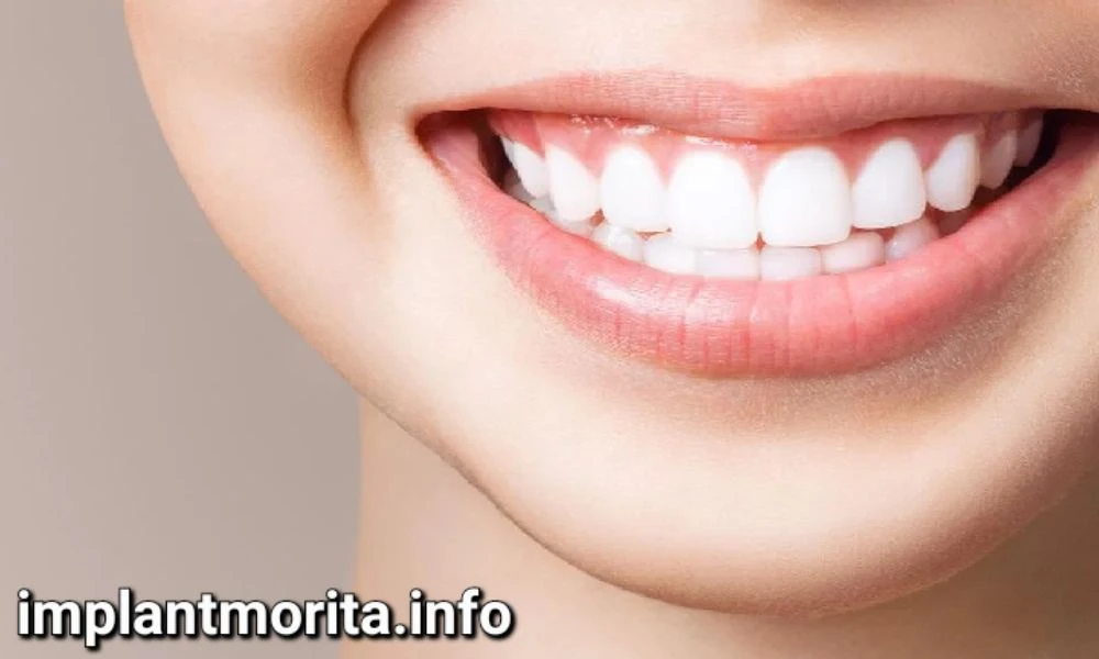 ایمپلنت دندان چند سال دوام دارد
