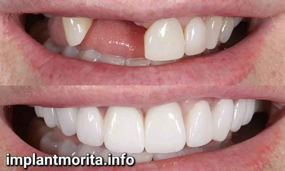 ایمپلنت دندان چند سال دوام دارد