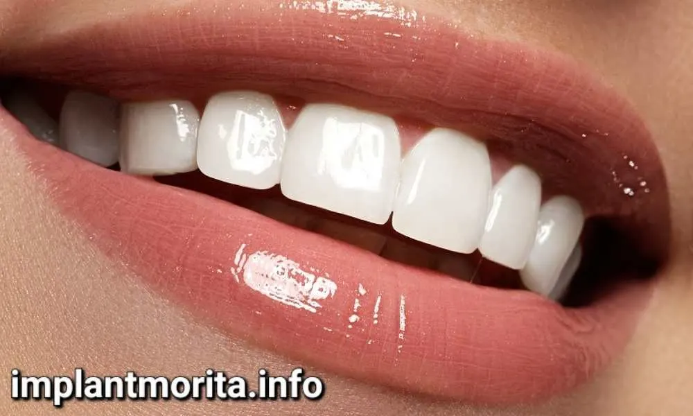 ایمپلنت دندان چند سال دوام دارد