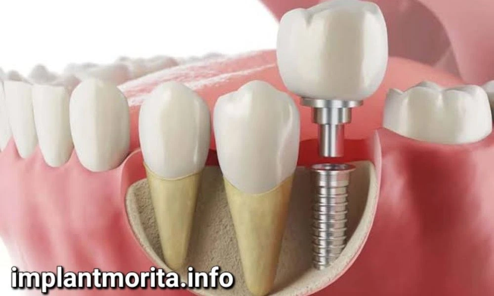 بهترین دندانپزشکان ایمپلنت ایران