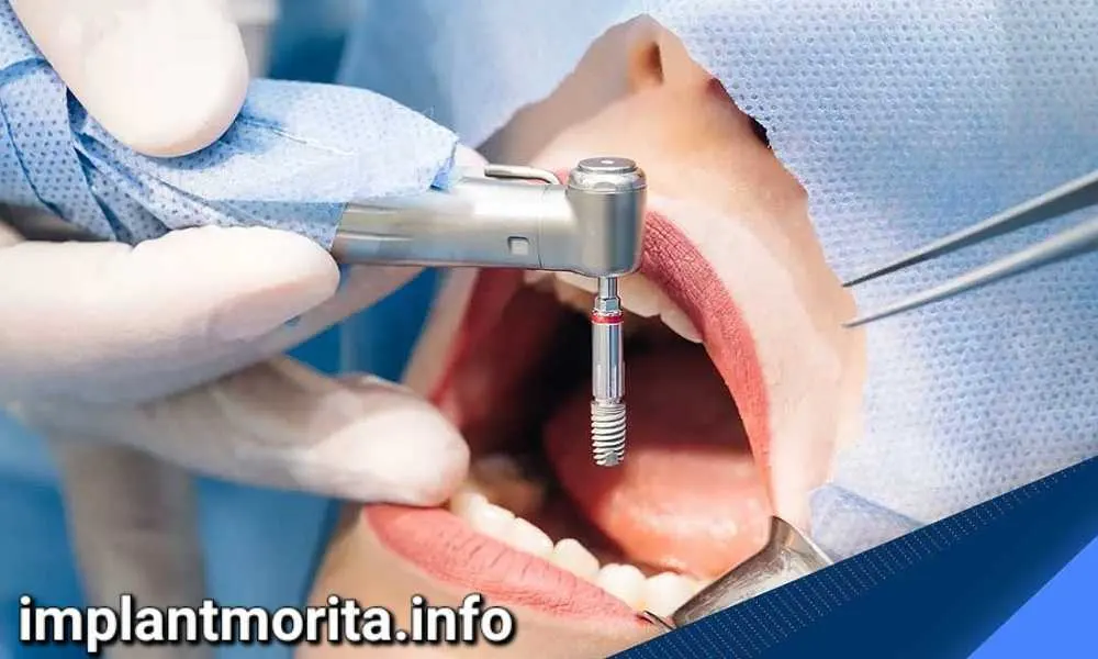 بهترین روشهای جایگزین دندانهای از دست رفته