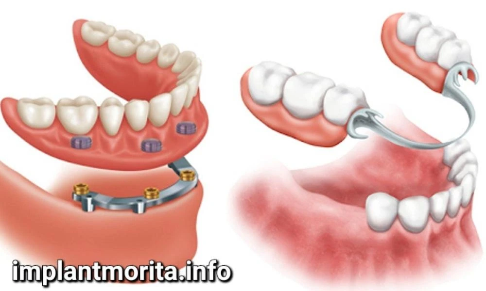 مزایا و معایب پروتز متحرک