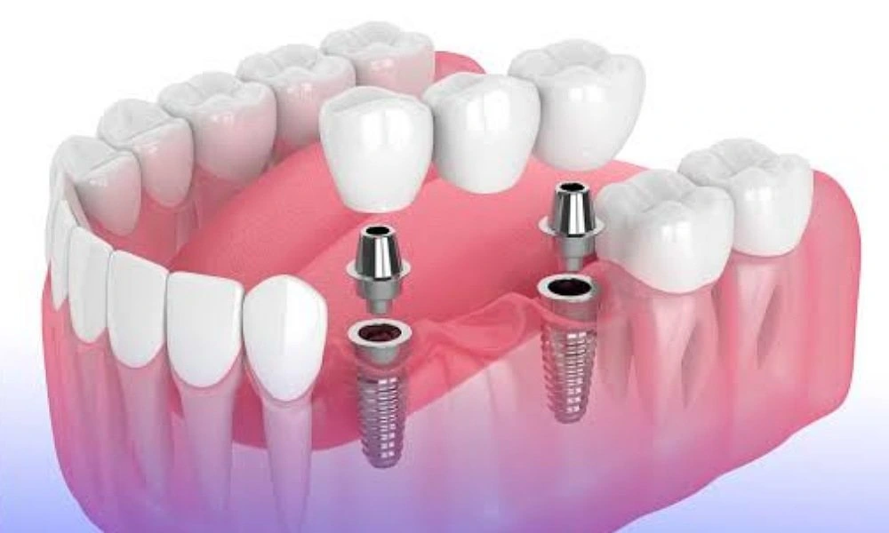 مقایسه بریج دندانی و ایمپلنت