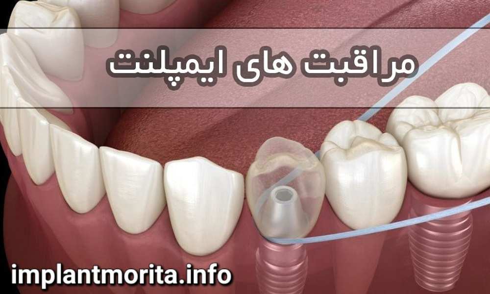 بعد از کاشت دندان چه مراقبت هایی لازم است