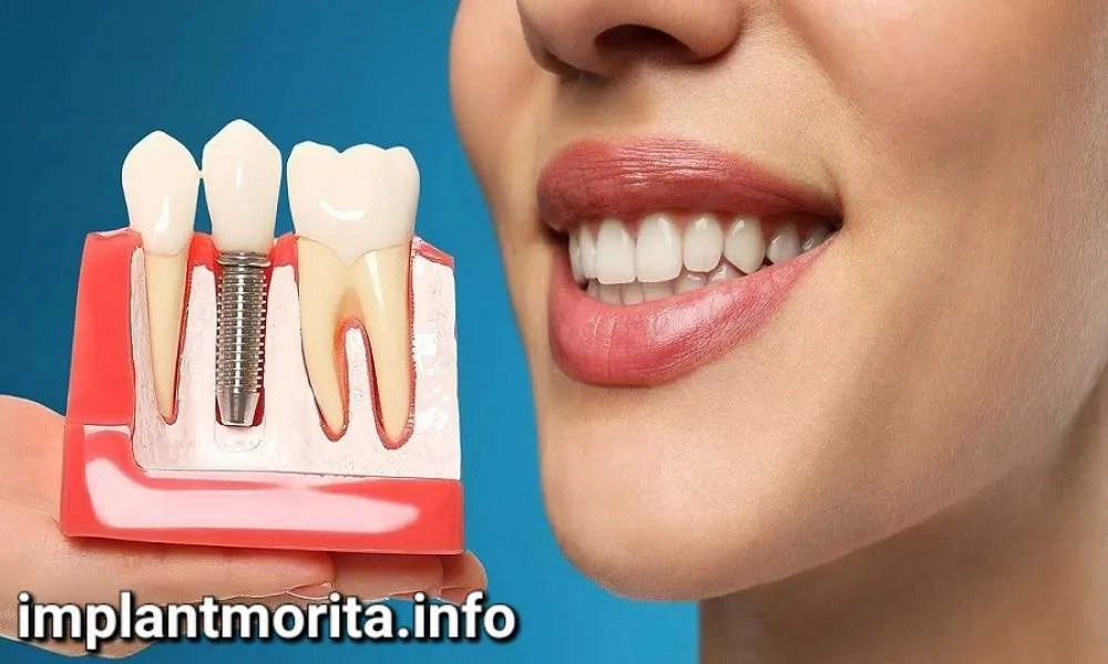 چه کسانی نمیتوانند کاشت ایمپلنت انجام دهند