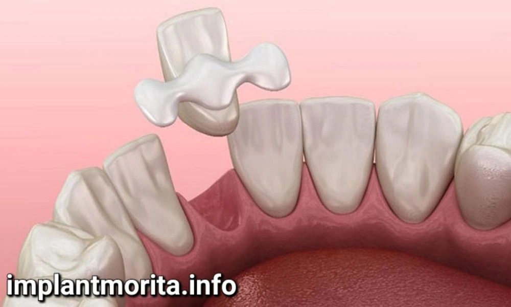 روش های جایگزین دندان های از دست رفته