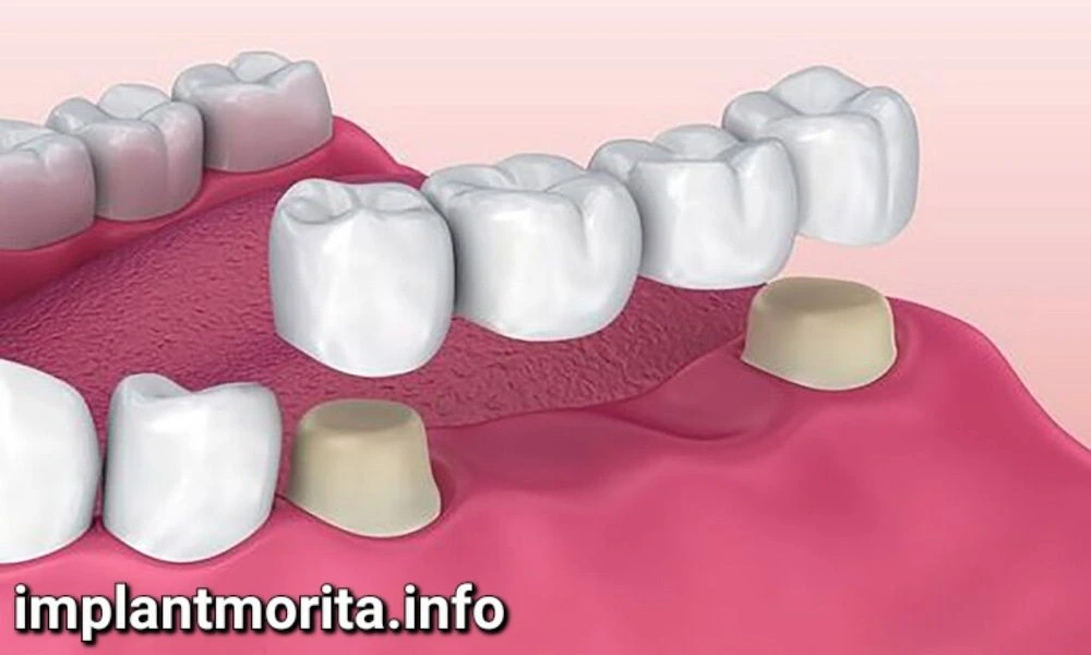 روش های جایگزین دندان های از دست رفته