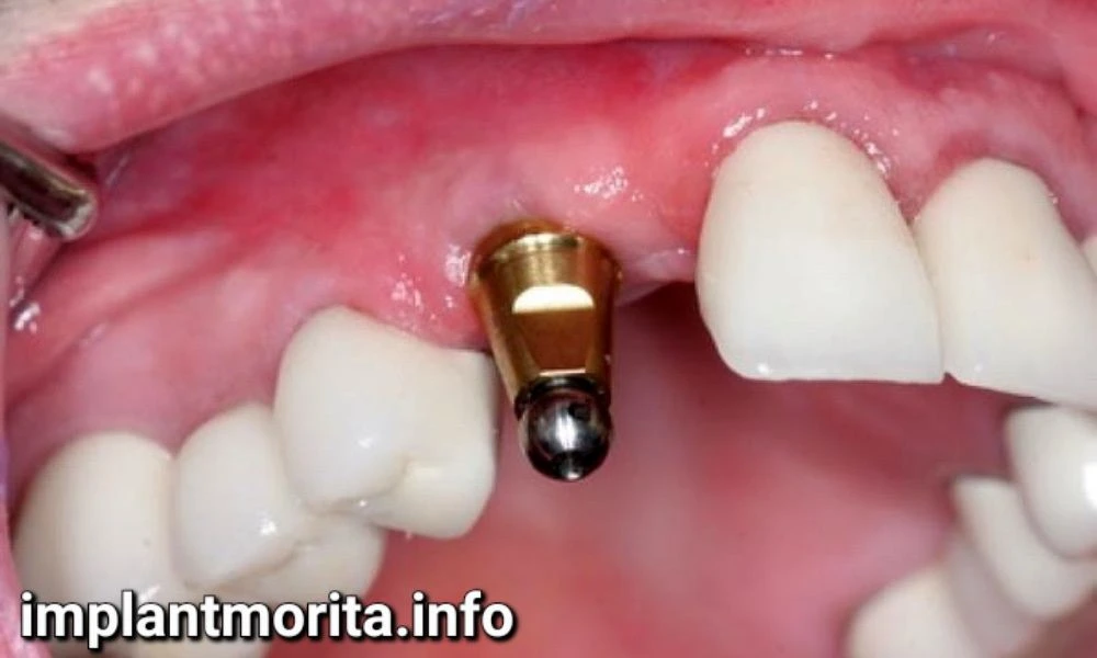 ایمپلنت دندان چگونه انجام می شود