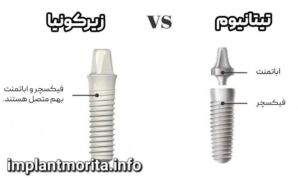 تفاوت ایمپلنت تیتانیومی و ایمپلنت زیرکونیا